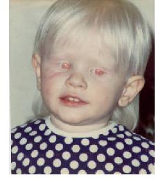 Albinism Eye Color